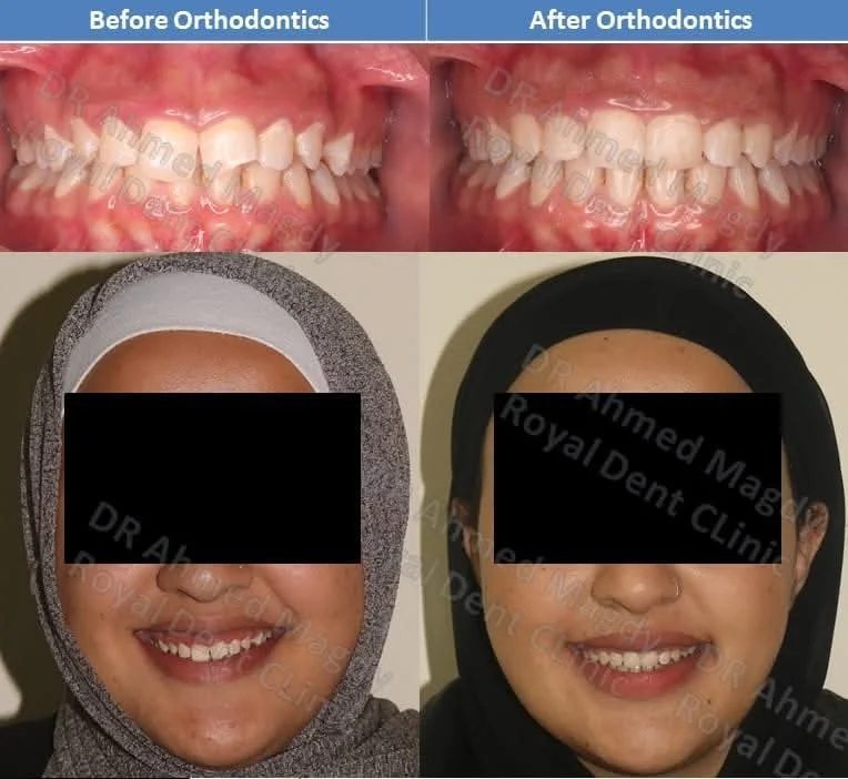 علاج ابتسامة لثوية بتقويم الاسنان - Dr Ahmed Magdy specialized in Orthodontics and Aligners