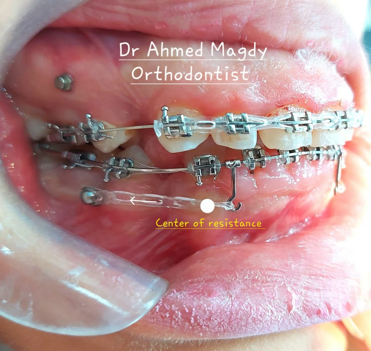 علاج بروز الاسنان - Dr Ahmed Magdy specialized in Orthodontics and Aligners