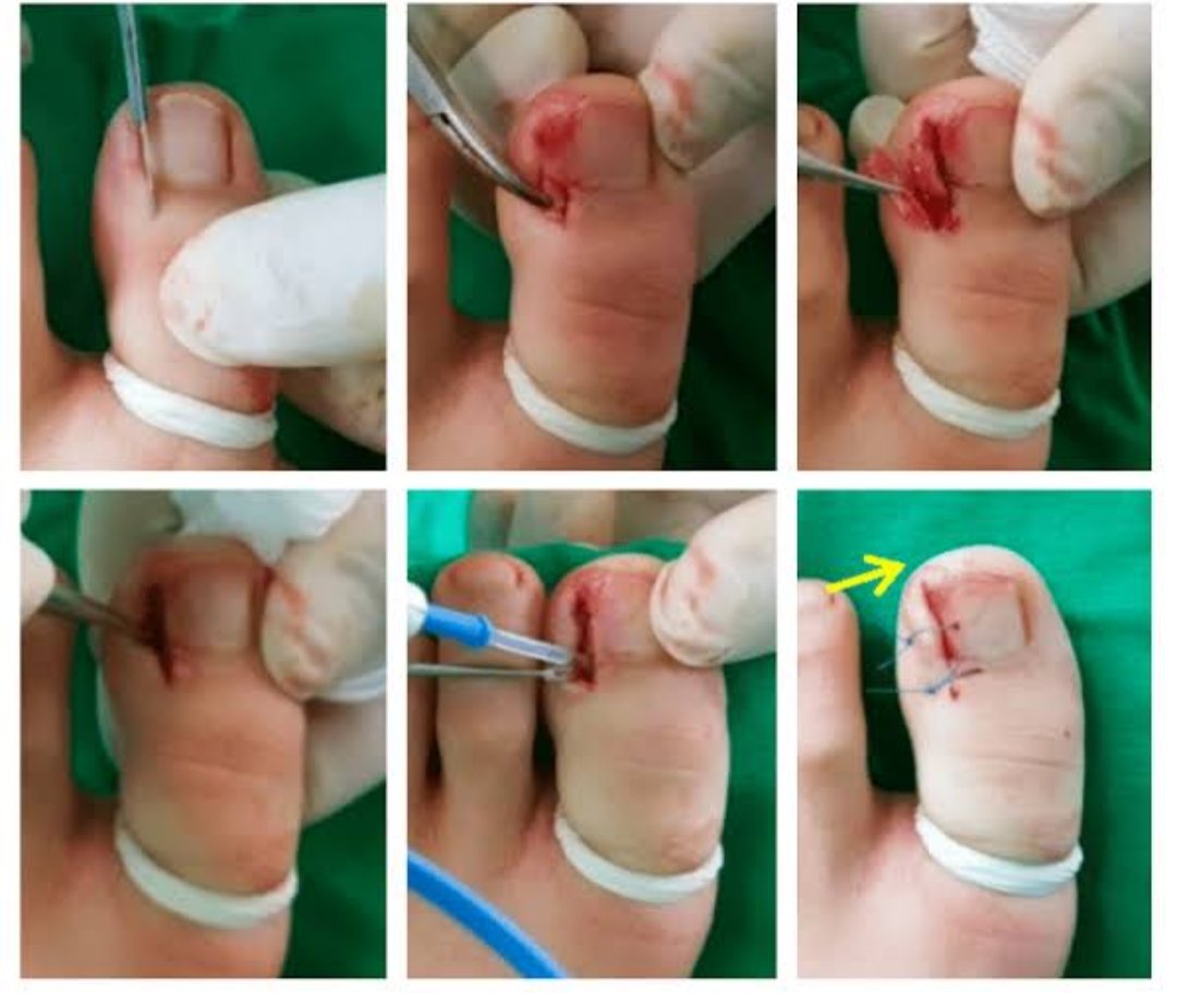 علاج الظفر الغائر