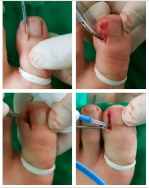 علاج الظفر الغائر بالقدم اليمنى واليسرى