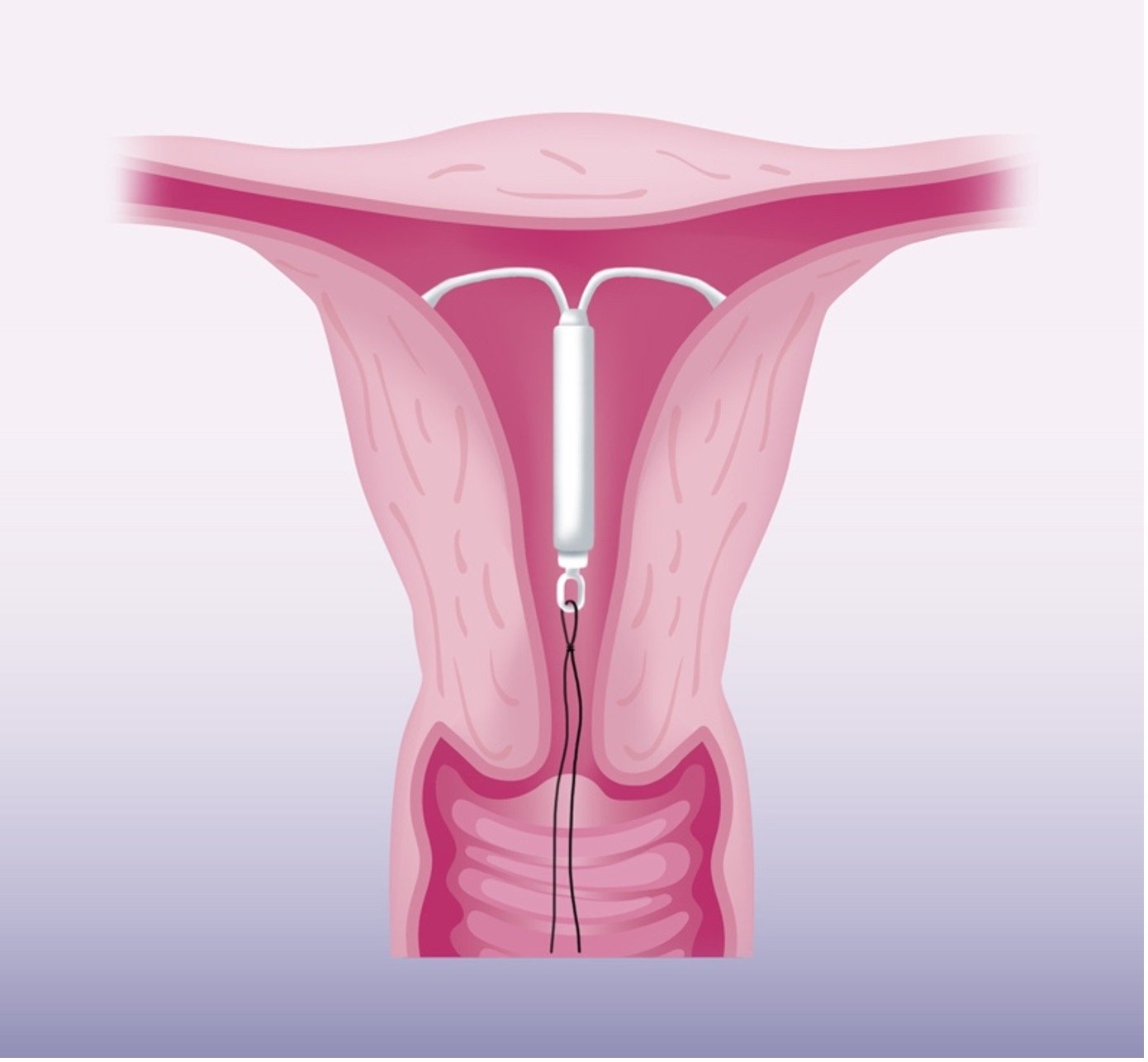 تركيب اللولب الهرموني بالسويس