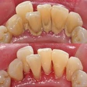 تنظيف وازالة الرواسب الجيرية وتلميع الاسنان