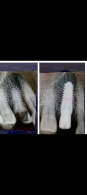 Last recent in implant branch  - Ibrahim Shahin's clinic